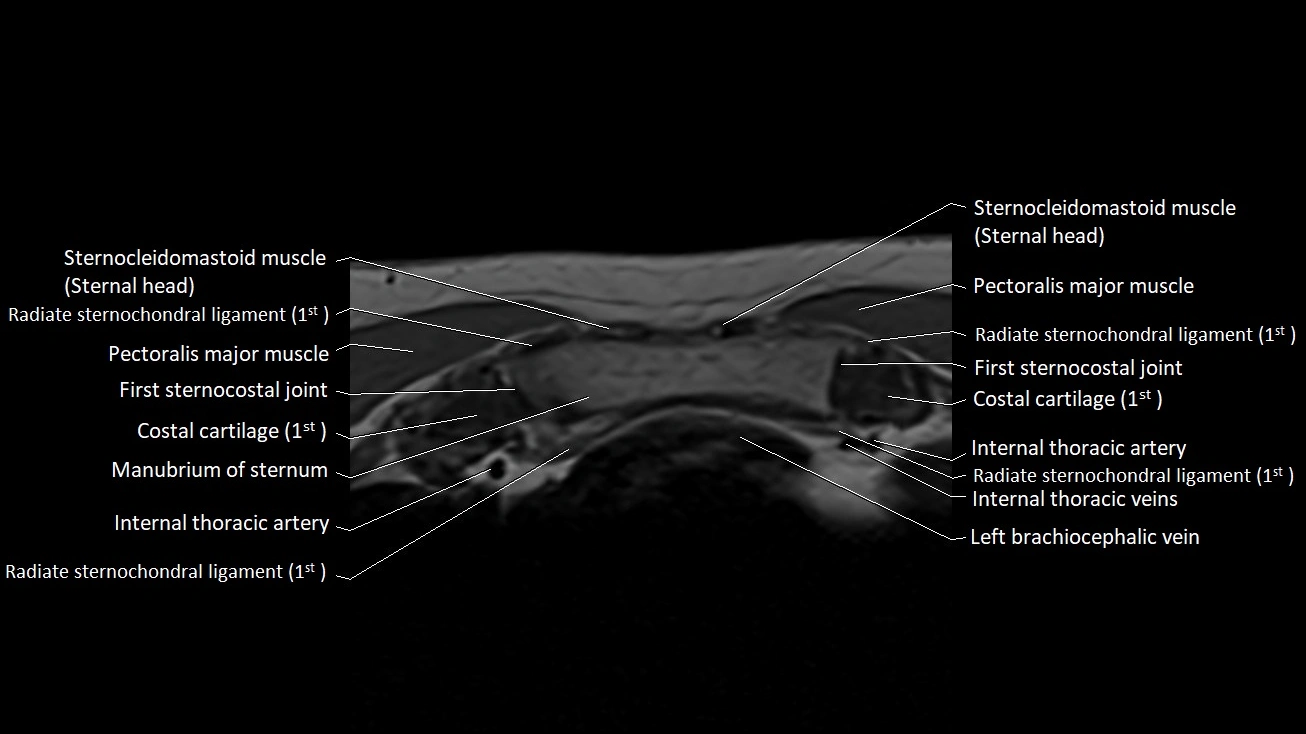 MRI sternum and sternoclavicular joint labeled axial anatomy image 7.webp